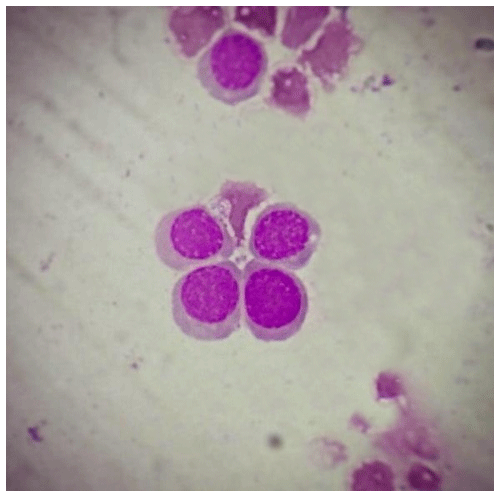 Megaloblastic Butterfly
Hatched from a bone marrow smear taken from a patient with megaloblastic anemia
i♡histo

Source
Histology by Haneen Al. Magrahbi
