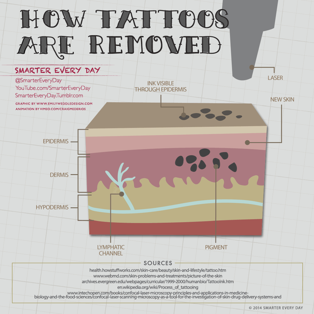 How laser tattoo removal works. Watch the video on Smarter Every Day .