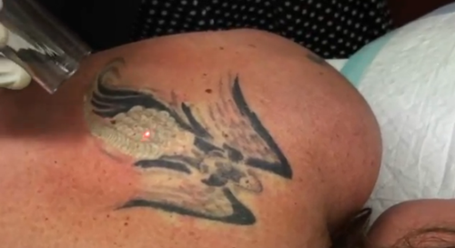Laser Tattoo Removal Melbourne
