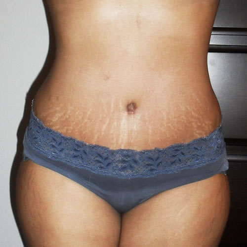 Stretch marks before and after weight loss