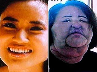 Big lips plastic surgery gone wrong