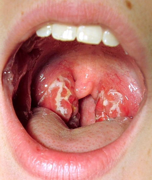 Viral vs bacterial throat infection