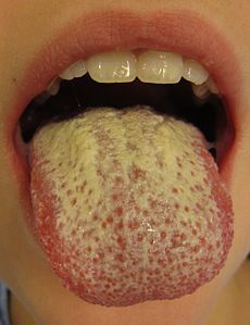 Candida yeast infection mouth