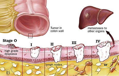 Giant cell tumor distal radius