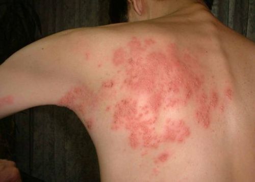 Pictures of roseola rash in children