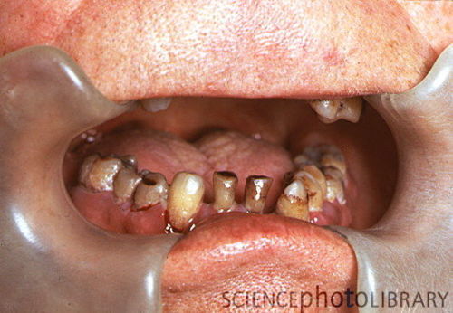 Abscess baby tooth gum line