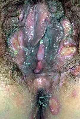 Men sexually transmitted diseases on penis