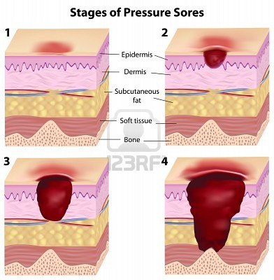 Ulcer sores on skin